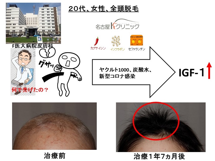 円形脱毛症　病院